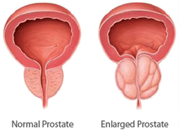 prostate-gland